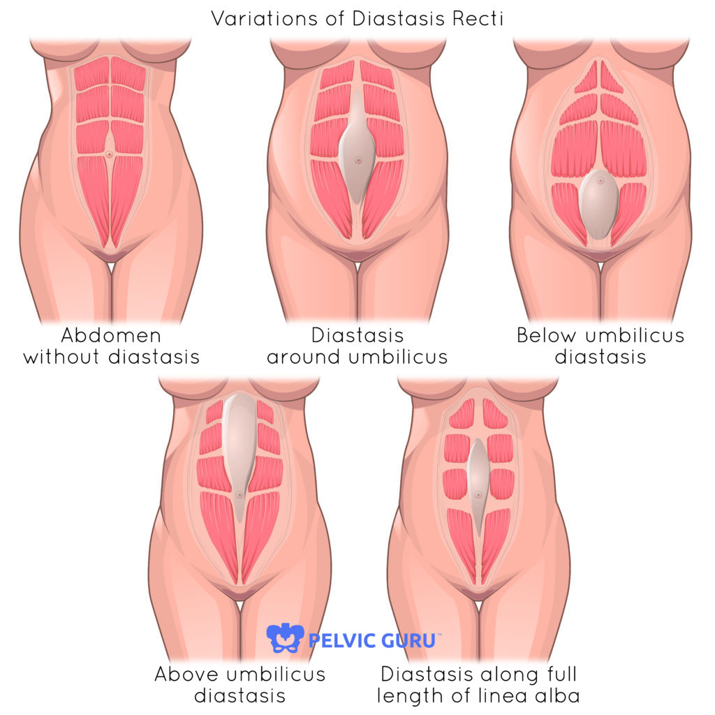 Do You Have Diastasis Recti You May Also Have Pelvic Floor