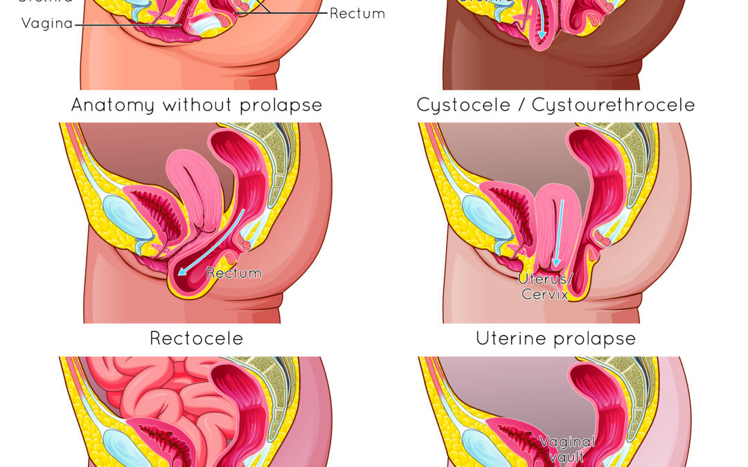 Pelvic Physical Therapy can help prolapse