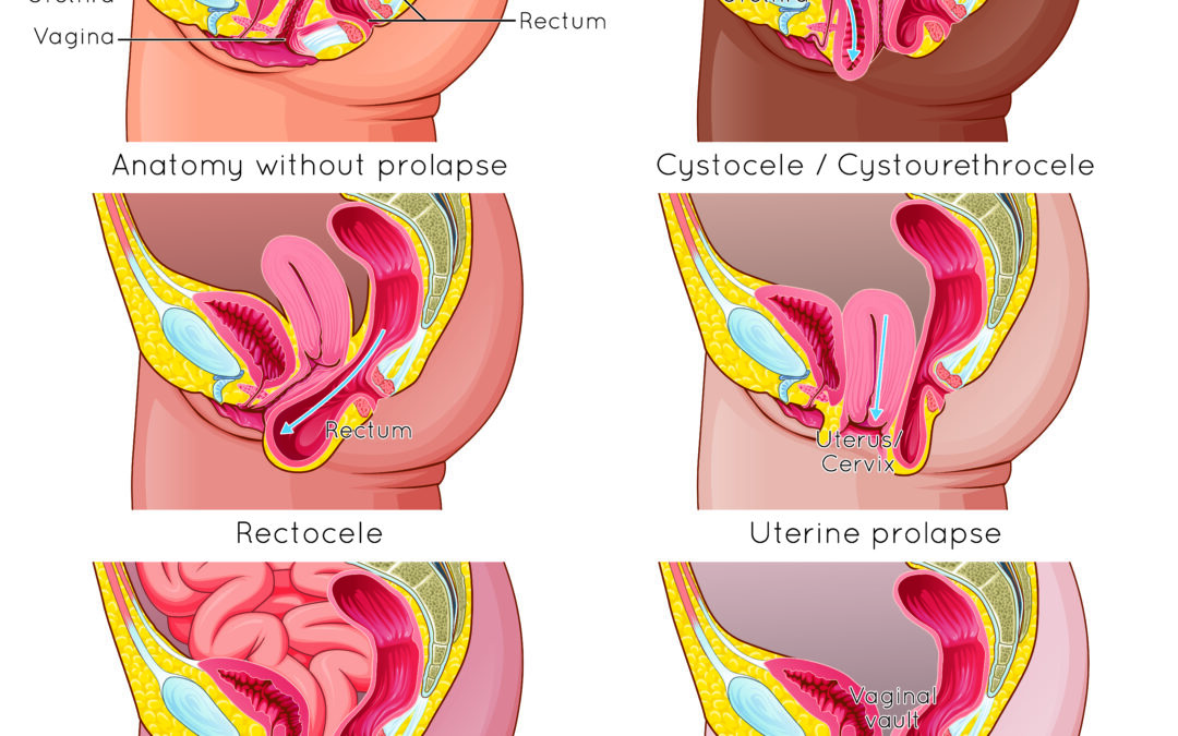 prolapse